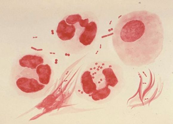 drug resistant gonorrhea std